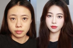 整容脸多少钱？手术费用和材料选择有关吗？