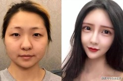 河南整形美容哪里好？如何避免整形失败？