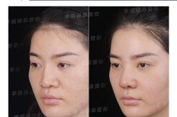 鼻综合整形价格高吗？和单纯隆鼻比哪个更值得？