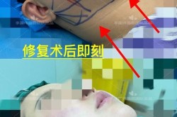 双下巴手术风险大吗？恢复期多久？