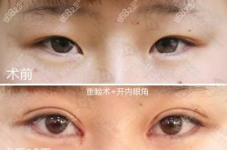 米亚整形做双眼皮怎么样？价格贵吗？