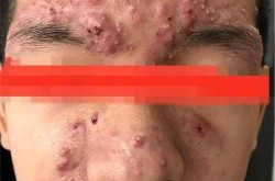 痘印痘坑怎么办？有没有不用手术的方法？