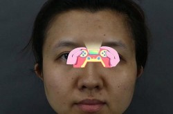 下颌角肥大矫正术怎么做？手术价格介绍！