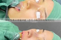 鼻梁矫正手术有哪些方法？哪种最自然？