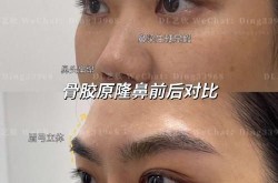 胶原蛋白隆鼻医院哪家好？手术效果怎么样？