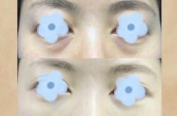 眼袋手术的价格是多少？恢复期需要多久？
