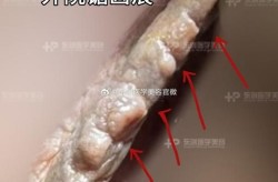 私密部位缩小手术安全吗？效果如何？