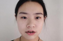 仰月唇图片是怎样的？这种整形手术适合谁？
