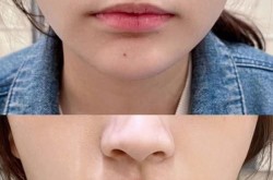 玻尿酸丰唇整形手术多少钱？效果怎样？