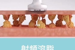 射频溶脂减肥效果如何？有哪些优点？