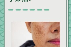 去除黄褐斑需要多少费用？有哪些方法？