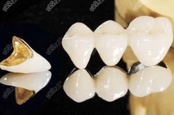 美容冠怎么样？与传统烤瓷牙有什么区别？