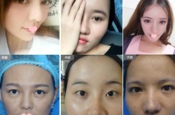 伊美尔幸福整形医院在眼部整形方面专业吗？