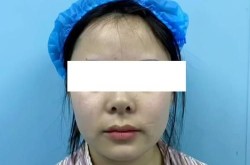 朝天鼻矫正手术多少钱？效果自然吗？