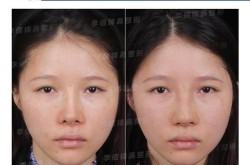 大鼻子整形的价格和手术过程是怎样的？