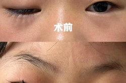 北京上睑下垂手术怎么做？有哪些成功案例？