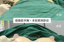 自体细胞丰胸价格是多少？手术安全吗？