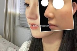 软骨隆鼻和硅胶隆鼻哪个更好？如何选择？