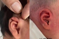 招风耳手术多少钱？有没有风险和并发症？
