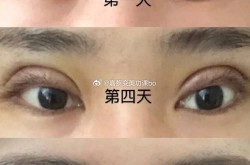 做哪种双眼皮手术效果最自然？