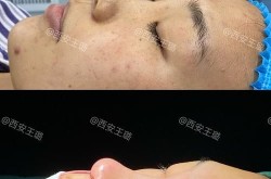 自体软骨隆鼻的效果好不好？多少钱？