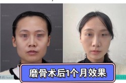国字脸整形怎么做？恢复期需要多久？