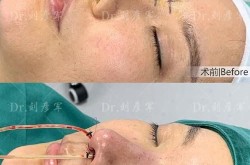 畸形鼻尖整形有哪些方法？哪种手术效果最自然？
