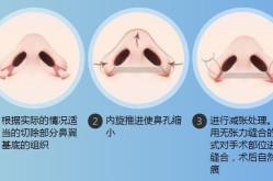 怎样使鼻头变小？非手术方法和手术方法哪个好？