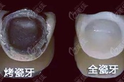 钯银合金烤瓷牙好不好？与传统烤瓷牙相比有什么优势？