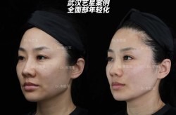 温州加美整形医院做面部年轻化技术怎么样？