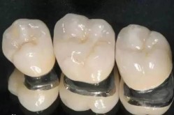 镍铬合金烤瓷冠的使用寿命是多久？有什么优缺点？
