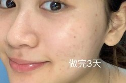 白瓷娃娃美容多少钱？效果如何？