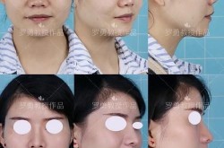 驼峰鼻矫正费用多少？手术效果持久吗？