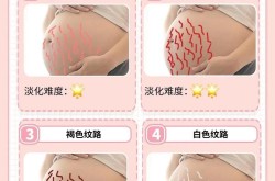 妊娠纹整形价格表解读，如何选择适合自己的治疗方式？