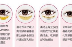 眼袋整型手术多少钱？恢复期要注意什么？
