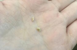 去牙石有哪些方法？哪种方式最安全有效？