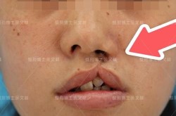唇裂整形手术的最佳时机是什么？成功率多高？