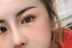 割双眼皮哪个医院好？求实力推荐！