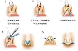 怎样让鼻孔缩小？整形手术还是其他方法？
