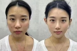 当代整形技术和传统整形相比有哪些优势？