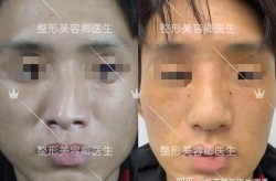 歪鼻整形需要多少钱？手术复杂吗？