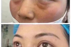 去除眼袋手术安全吗？有没有不手术的方法？