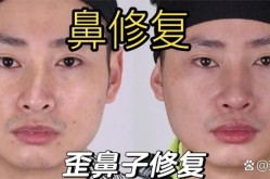 歪鼻整形要多少钱？手术效果可以维持多久？