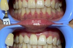 美白牙齿需要多少钱？冷光美白靠谱吗？